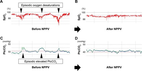 Figure 3 (A) SpO2 monitoring during sleep before NPPV, (B) SpO2 monitoring during sleep after NPPV, (C) PtcCO2 monitoring during sleep before NPPV, (D) PtcCO2 monitoring during sleep after NPPV.