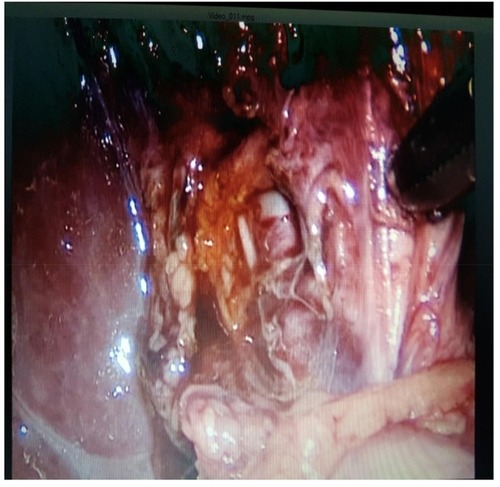Figure 2 Site of injury to the ARHD after extraction of the gall bladder.