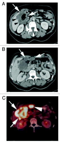 Figure 1. (A) Contrast enhanced CT of the abdomen shows a large, circumferential mass involving the hepatic flexure (white arrows). The mass infiltrates the adjacent right liver lobe (black arrows). (B) Contrast enhanced CT of the abdomen slightly more superiorly in the abdomen show two soft tissue nodules in the adjacent pericolonic fat (white arrows), consistent with peritoneal metastasis. (C) PET-CT fusion image at the level of the mass shown in (B) shows a markedly FDG avid hepatic flexure mass (white arrows), as well as marked FDG avidity of the pericolonic metastasis (arrow heads).