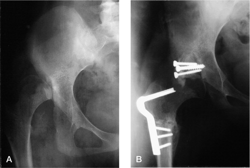 Figure 2 Case 2. A 12.5-year-old girl at the index operation (A) for dislocation of the right hip and postoperatively (B) after open reduction, capsulorhaphy, extraarticular grafting arthroplasty and femoral shortening, showing adequate reduction.