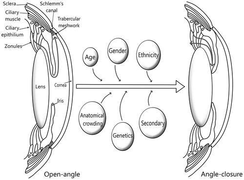 Figure 1 Schematic representation of risk factors contributing to angle-closure in PACG. The curved arrow from the ciliary epithelium indicate the normal flow of aqueous humor in open-angle which is blocked in angle-closure.
