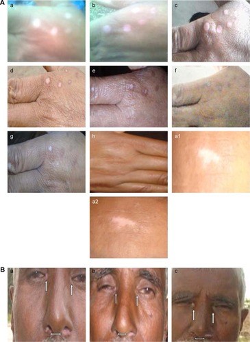 Figure 6 (A–C) Evolution of pigmentation.