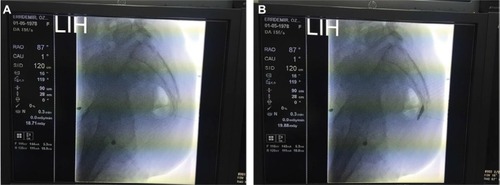 Figure 3 Fluoroscopic view of ganglion impar block before (A) and after (B) the administration of contrast agent.