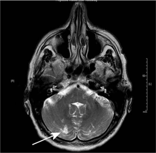 Figure 2 MRI of a 61-year-old patient with embolic silent brain infarction in cerebellum (arrow).