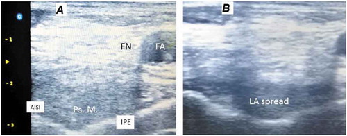 Figure 2. Ultrasound view showing land marks for the PENG block (A) and local anesthetic spread (B).