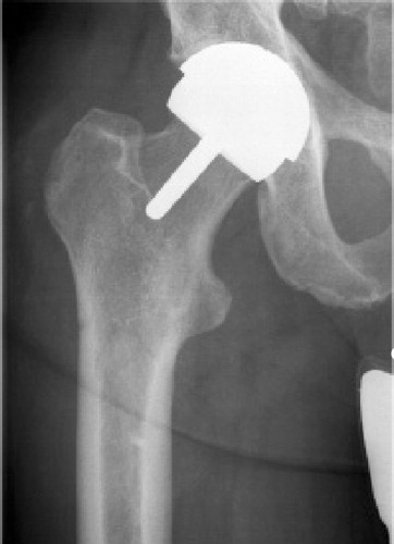 Postoperative radiograph of the presented patient after implantation of the THRA.