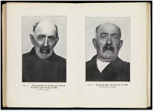 Figure 1. A characteristic image of claimed rejuvenation, published in one of Serge Voronoff’s most complete accounts of his methods.Notes: The patient, Georges Behr, is pictured prior to treatment at the age of 73 and one year later after the gland-grafting operation which gained much notoriety throughout the Western world in the interwar period. Serge Voronoff, Étude sur la vieillesse et la rajeunissement par la greffe, Paris: G. Doin, 1926, reproduced by kind permission of Wellcome Library, London, L0068506.