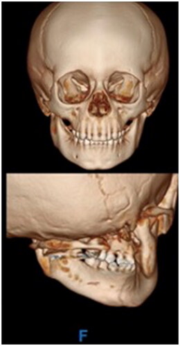 Figure 5. The follow-up CT maxillofacial scan at 5-months post-initial surgery demonstrated relocation, remodeling, and bony healing. Specifically, the left TMJ is restored and relocated, the right condylar fracture has remodeled and is in nearly anatomic pre-injury location, and the symphyseal fracture has healed.