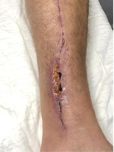 Figure 2 Day 1: Wound pre-debridement.