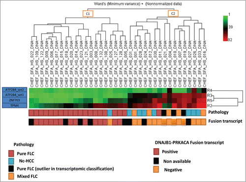 Figure 5. Unsupervised clustering for DNA methylation using 4 sets of differentially methylated genes. Note that all but one pure fibrolamellar hepatocellular carcinoma (FLC) belong to cluster C1, while mixed fibrolamellar carcinoma and hepatocellular carcinoma in non-cirrhotic liver belong to cluster C2. For the only pure FLC which clustered within C2 cases, no RNA was available to check for the presence of fusion transcript.