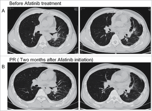 Figure 1. Chest computed tomography scan revealed the tumor response to afatinib. (A) The progressive disease status of lung lesion before afatinib treatment. (B) The partial response of lung lesions after afatinib treatment.