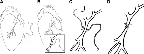 Figure S1 Illustration showing localization of the left coronary artery (A) and the steps of ligation of the left coronary artery (B–D).