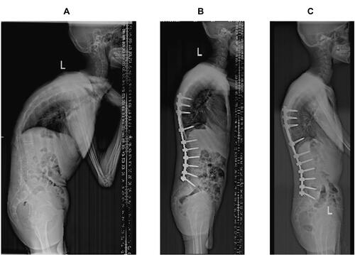 Figure 2 A 49-year-old male patient. (A) It shows the disease is located at the apex of T11–12 before the operation, and the patient is allocated to the lumbar kyphosis group. (B) Single segmental PSO surgery is performed at T12. The GK and SVA are corrected to 61° and 72.31 mm from 93° and 274.29 mm, respectively. (C) During the follow-up, the GK increases to 57, and the LL is improved to −56° from −28° in the final year. No obvious correction loss is observed.
