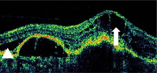 Figure 10 Stratus optical coherence tomography image.