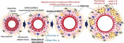 Figure 6. Putative potential mechanism underlying the ectopic appearance of adipocytes in the AAA wall. Hypoperfusion in the aortic wall due to the obstruction of the vasa vasorum resulted in the appearance of CD44+CD90+ MSCs in the aortic wall. The increased CD44+CD90+ MSCs differentiated into abnormal adipocytes in the vascular wall with the expression of adipocyte differentiation regulatory factors. The appearance of adipocytes can cause a weakness of the vascular wall. It should be noted that this schema is a simplified focused on the adipocytes in the vascular wall. In the actual AAA wall, various pathological events, not only adipocytes accumulation, but also extracellular matrix degradation, microcalcification, and oxidative stress in the media, are involved in the development of AAA. Further studies are needed to elucidate the relationship between adipocyte infiltration and other AAA events.