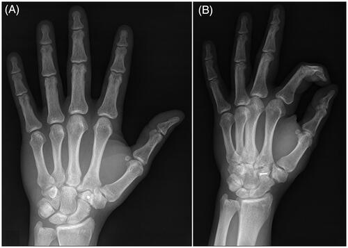 Figure 6. Radiographs of the left hand at the two years follow-up visit demonstrating congruency of all carpal bones and carpometacarpal joints and no signs of avascular necrosis or arthritis.