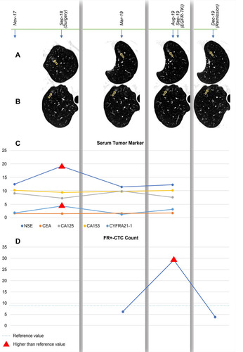 Figure 1 The examination results of CT, serum tumor marker and FR+-CTC were described in chronological order, included the time before operation, follow-up without medication and after EGFR-TKI treatment. (A and B). CT image of unresected GGO lesions in left upper lobe (LUL) and right upper lobe (RUL) in patients, showing the enlargement and remission of lesions. The yellow arrows in A and B pointed to the location of lesions in the CT images. (C and D). Line chart showed the changes in value of serum tumor marker and FR+-CTC in different periods of time.