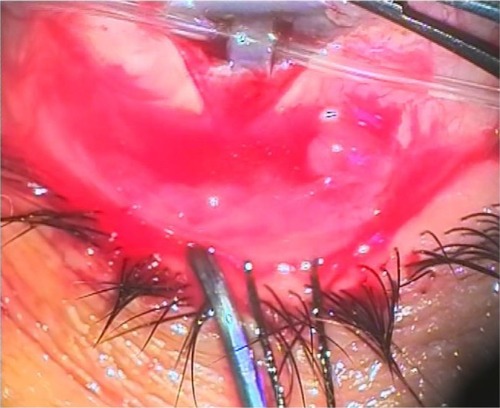 Figure 4 Passage of a silicon tube through the anterior chamber.
