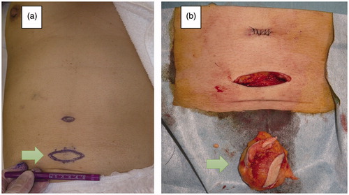 Figure 2. (a) Preoperative appearance. (b) The excised mass with indurated subcutaneous fat.
