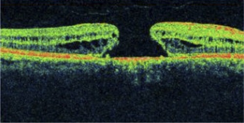 Figure 2 Macular hole with disrupted ISel and ELM.