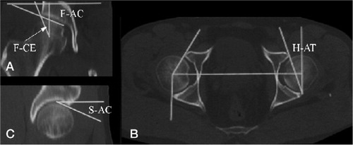 Figure 1. Reformatted CT slices:A) frontal view, B) horizontal view, and C) sagittal view.The realignment angles shown in their respective views are as follows.F-AC:articular cartilage angle in the frontal plane;F-CE:center edge angle in the frontal plane;S-AC:articular cartilage angle in the sagittal plane;H-AT:anteversion angle in the horizontal plane.F-AC angle was defined as the angle between the horizontal line and a line connecting the medial edge of the sourcil line and the most lateral point on the acetabulum (points 4 and 5 in Figure 3), measured clockwise. F-CE angle was defined as the angle between a vertical line passing through the center of the femoral head and a line between the center of the femoral head and the most lateral edge of the acetabulum, measured counterclockwise. S-AC was defined as the angle between a horizontal line and a line passing through the anterior edge of the contact surface, and the upper most point of the acetabular contact surface.H-AT was defined as the angle of a line parallel to the opening of the acetabulum and a line perpendicular to the line drawn through the centers of the femoral heads.