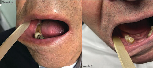 Figure 1. Clinical image.Example of a case of medication-related osteonecrosis of the jaw treated with allogeneic platelet-rich plasma. Left: Before al-PRP treatment (baseline). Right: Control after 7 weeks of treatment.