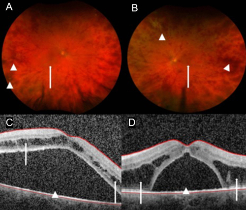Figure 2 Pre-Treatment Fundoscopic Evaluation and Optical Coherence Tomography. Patient’s initial visual acuity of 20/150 OD and 20/100 OS correlates with initial fundoscopic exam showing evidence of venous occlusive disease with circumferential hemorrhages (arrow heads) and macular edema (arrows) on fundus exam ((A) OD; (B) OS). Initial OCT shows significant bilateral subretinal fluid (arrow heads) and bilateral intraretinal fluid (arrows), more prominent OS ((C) OD; (D) OS).