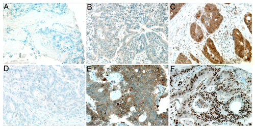 Figure 1. Representative images of CIP2A and c-Myc expression in colorectal cancer. (A) CIP2A negative, (B) weakly positive, and (C) strongly positive immunoreactivity. (D) Negative c-Myc cytoplasmic and nuclear immunoreactivity. (E) Strongly positive cytoplasmic c-Myc immunoreactivity, and (F) over 80% positive nuclear c-Myc immunoreactivity. Original magnification was 200x.