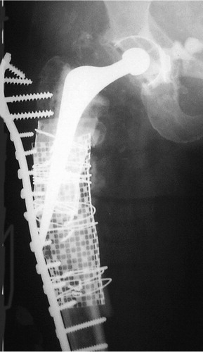 Figure 5. Long DCP plate pulled away from the bone due to nonunion.