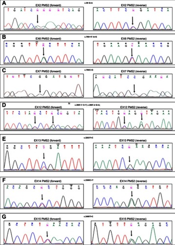 Figure 1 DNA sequencing electropherograms of the PMS2 exon 2 (A), exon 6 (B), exon 7 (C), exon 12 (D), exon 13 (E), exon 14 (F), and exon 15 (G) for the 07/6 patient sample. Arrows indicate the homozygous variant in the exon 7 (C), and the heterozygous variants in the exon 2 (A), the exon 6 (B), the exon 12 (D), the exon 13 (E), the exon 14 (F), and the exon 15 (G). Each variant is shown in the forward (left) and reverse (right) DNA sequencing analysis.