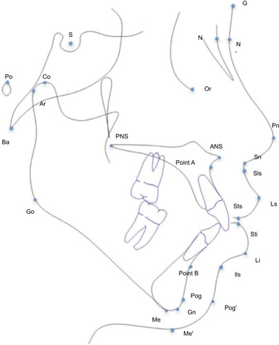 Figure 1 The skeletal, dental, and soft tissue landmarks used in the study.
