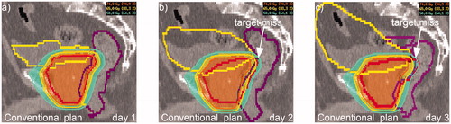 Figure 1. PTV-based IMRT plan. A conventional IMRT plan (i.e., cPTV1) was generated and demonstrated with cPTVs and OARs on day1-3 (a-c) indicating target miss at day 2-3 (b-c).