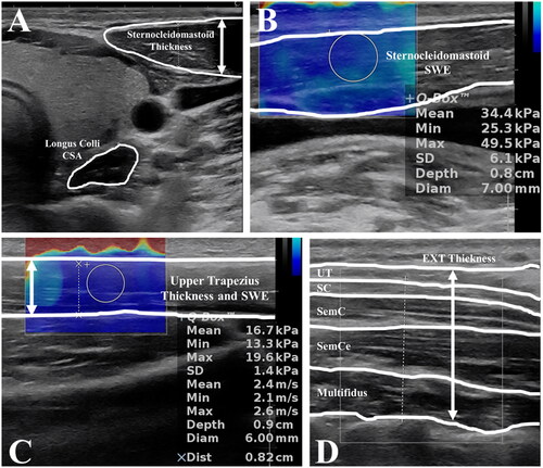 Figure 4. Ultrasound images: A. the sternocleidomastoid thickness and the longus colli cross-sectional area (CSA); B. the sternocleidomastoid shear wave elastography (SWE); C. the upper trapezius thickness and shear wave elastography; and D. the cervical extensors (EXT) thickness.