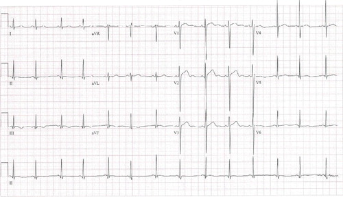 Figure 1. An electrocardiogram taken at the time of chest pain showing ST elevation over the anterior leads and T wave inversion over the inferior leads.