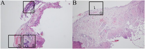 Figure 2. (a)Vesicular lesion(HE × 40). (b)Vesicular lesion(HE × 100).Vesicular lesion: the ectopic lesions were visible both supraperitoneally and subperitoneally; they were distributed close to the peritoneum, with a regular glandular structure, flattened cavity, and sparse occurrence of peri-glandular stromal cells, as indicated in (a) marker ①; scattered hemorrhages were visible subperitoneally, as indicated in (a) marker ②; and the peritoneal mesothelial tissue was structurally intact and continuous, as indicated in (b) marker ①.