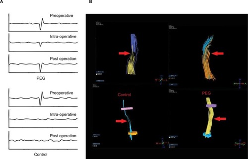 Figure 4 (A) Waveform of somatosensory evoked potentials before and after (15 days) spinal cord transection for PEG-treated and negative control groups. PEG treatment elicited some recovery in the shape of the waveform compared to no treatment at all. (B) Diffused tensor imaging of spinal cord transection with/without PEG treatment. PEG treatment group led to greater continuity of nerve fibers compared to no treatment.