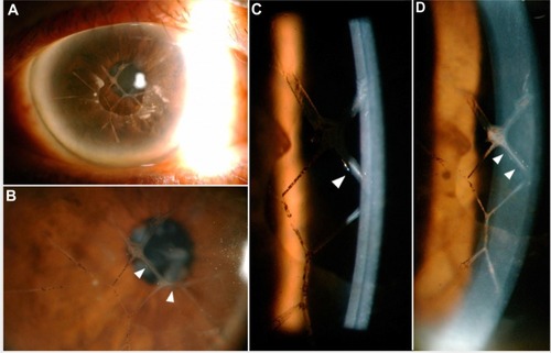 Figure 1 Slit-lamp photograph of the right eye.