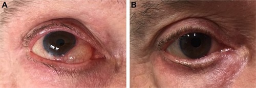 Figure 7 (A) Hypertrophic XEN45 bleb; (B) after inferior bleb needling.