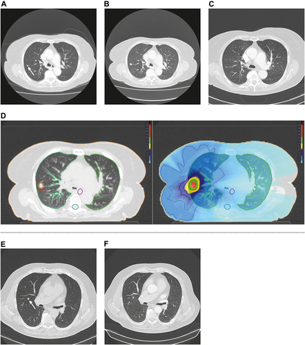 Figure 4 Local control after SBRT. (A–D): (A): 86-year-old woman with a metachronous (5 mm) lung metastasis of colon carcinoma (white arrow). Due to the age, no histological verification was done. (B): Follow-up after 3 months. Increase in size to 8 mm, decision for SBRT. (C): Tumour response 3 months after SBRT, size decrease by 2 mm, no evidence of radiation pneumonitis. (D left): Tumour within the planning target volume (red contour) and organs at risk: Total lung (green), spinal cord (turquoise) and oesophagus (violet).(D right): Treament plan: High-dose region surrounding the tumour (red, green), step down gradient (yellow, dark blue), and a large low-dose region highlighted in blue. The patient was treated with a dose of 15 Gy in 3 fractions (total dose 45.0 Gy). (E and F): Another patient treated with SBRT (7.5 Gy in 8 fractions, total dose 60.0 Gy) for lung metastasis of colon carcinoma (white arrow) had tumour response on follow-up at 3 months after SBRT. No radiation pneumonitis.
