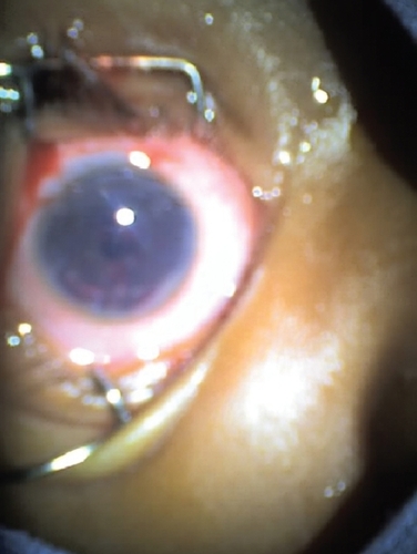 Figure 3 Eye after extracapsular surgery.