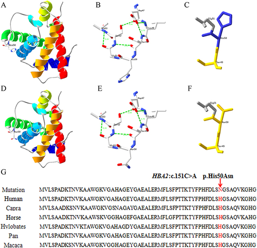 Figure 3 Protein three-dimensional structure prediction and conservation analysis of the Hb Guiyang. (A, B and C) are the three dimensional structure prediction and the partial enlargement of wild-type protein. (D, E and F) are the mutant protein. (G): the positions p.His50 in the HBA2 protein are highly conserved among six species.