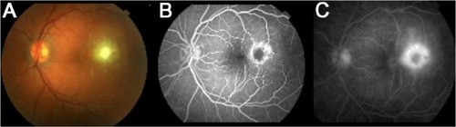 Figure 1 Color fundus photography (A) and fluorescein angiography (B and C) of the left eye.