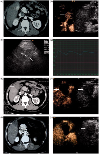 Figure 1. A 45-year-old man with HCC in the right lobe of the liver treated with RF ablation combined with PEI. (A) Before ablation, contrast enhanced CT scans shows a 2.3-cm tumour located at the edge of hepatic segment V adjacent to the hepatic flexure of colon (arrowhead). (B) Before ablation, CEUS shows the tumour hyper-enhanced in the arterial phase. (C) Two RF ablation needles (short arrowhead) were placed into the tumour and one thermal monitoring needle (long arrowhead) was placed into the margin of the tumour proximal to the hepatic flexure of the colon for real-time temperature monitoring during the procedure. (D) The temperature monitoring curve during RF ablation for a tumour adjacent to the gastrointestinal tract. The temperature of the marginal tumor tissue adjacent to the gastrointestinal tract was monitored and controlled to fluctuate between 45 °C and 56 °C during the whole treatment procedure. (E) Contrast enhanced CT 3 months after treatment shows the tumour (arrowhead) is completely ablated. (F) CEUS 3 months after treatment shows the tumour is completely ablated. (G), Contrast enhanced CT scan 18 months after treatment shows the ablation zone (arrowhead) had no enhancement. (H) CEUS 18 months after treatment shows the ablation zone (arrowhead) had no enhancement.