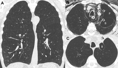 Figure 2 Chest CT evolution (patient 2). (A) Baseline chest CT. Presence of homogeneous emphysema. (B) Chest CT performed 5 days after valves insertion in the left upper lobe. Presence of pneumothorax (P), pneumomediastinum, subcutaneous emphysema and 2 chest tubes. Apparition of a bulla (B) in the left lung fissure. (C) Chest CT performed 84 days after valves insertion with resolution of air leak and decreasing size of the bulla (B) and an atelectasis (A).