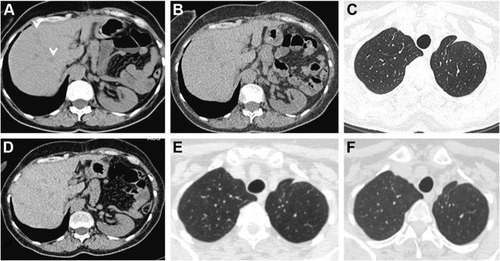 Figure 2 Subsequent CT findings.