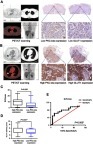 Figure 1 PKC-iota is associated with GLUT1 and SUVmax in primary NSCLC. (A, B) Images of 18F-PET/CT scanning, H/E staining, PKC-iota staining, and GLUT1 staining of primary NSCLC tissues of a patient (A) with relatively low 18F-FDG uptake (SUVmax =3.59) and low PKC-iota and GLUT1 co-expression (scale bar: 25 μm) and another patient (B) with relatively high 18F-FDG uptake (SUVmax =16.47) and high PKC-iota and GLUT1 co-expression (scale bar: 25 μm). (C) NSCLC tissues with high PKC-iota expression (10.07±1.09) accumulated much more 18F-FDG than tissues with low PKC-iota expression (5.28±1.28). (D) NSCLC tissues with high PKC-iota expression (5.03±0.41) expressed much more GLUT1 than tissues with low PKC-iota expression (3.75±0.40). (E) ROC curve analysis of SUVmax for predicting high PKC-iota expression. With a SUVmax cutoff value of 8.38, the sensitivity and specificity for high PKC-iota expression prediction were 62.07% and 87.50%, respectively (P=0.005; area under the ROC curve: 0.757; 95% confidence interval: 59.11% to 89.21%).