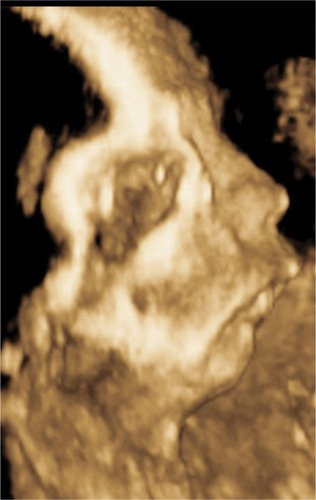 Figure 3 3-D rendering of the fetal face, demonstrating micrognathia.