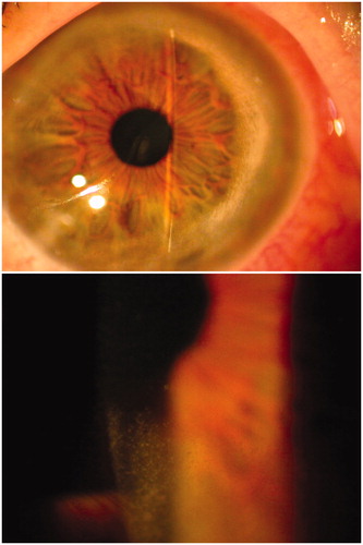 FIGURE 1. Peripheral progressive cicatrizing glaucomatous sclerosing endotheliitis. The lesion is seen advancing circumferentially and centrally.