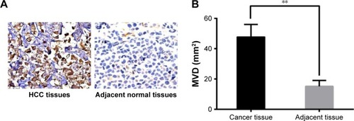 Figure 2 Comparison of microvessel density in the HCC and adjacent normal tissues. (A) The CD34 expression in HCC tissues and adjacent normal tissues (×400); (B) Comparison of MVD in the HCC and adjacent normal tissues; **P<0.01 compared with the adjacent normal tissues.