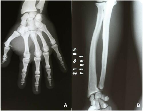 Figure 2 Radiological aspects of patient’s hand (A) and humerus and radius (B).